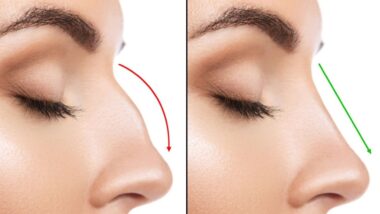 rinoplastia
